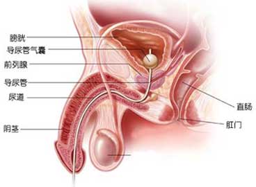 尿道下裂是指前尿道发育不全而导致尿道开口达不到正常位置的泌尿系统